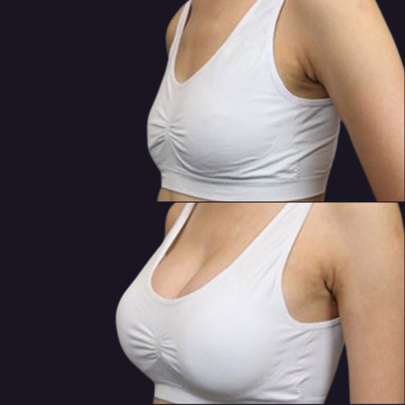 Breast augmentation before and after, side view, implant settled into position