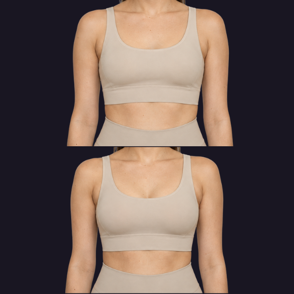 Breast augmentation before and after, front view, balanced and proportionate result