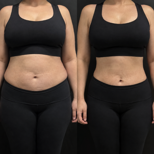 Liposuction before and after, front view, abdomen and waist contoured