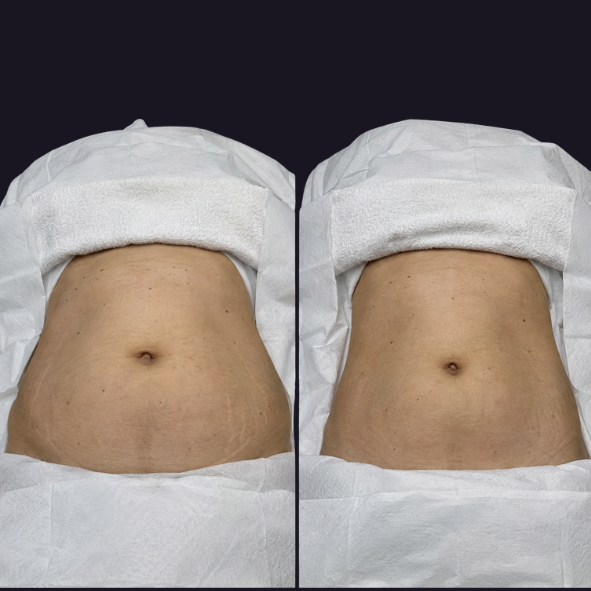 Liposuction before and after, close view of the abdomen after healing