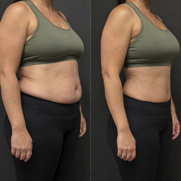 Liposuction before and after, three quarter view, waist and flank definition